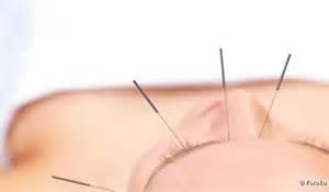 Acupuncture Needles Example