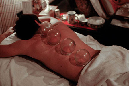 Cupping Treatment