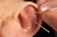 Auricular (ear) Acupuncture