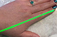 Laser Acupuncture