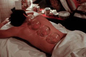 Cupping (for targeting nerves; releasing tension and stress)